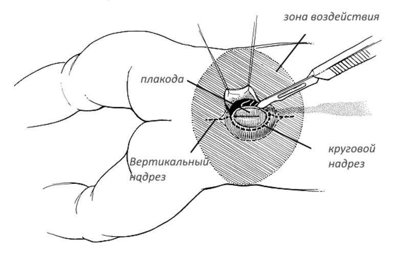 Сделайте кольцевой надрез. Внутриутробная операция спина бифида. Спина бифида Оккульта у взрослых. Диспластическая spina Bifida posterior s1.